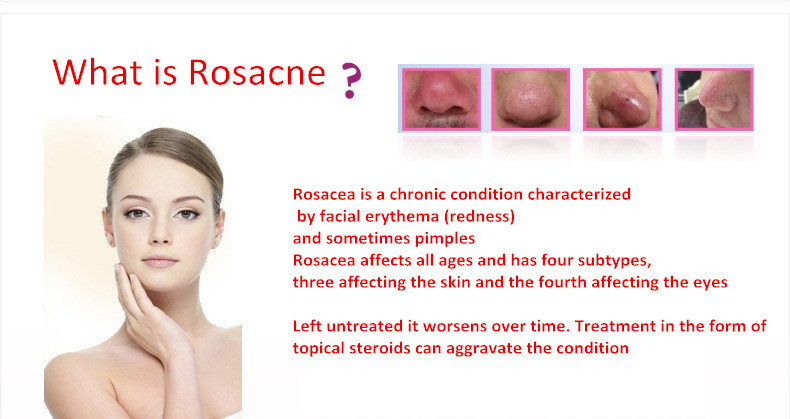 Rosacea Treatment Pictures Causes Diet And Triggers Women Daily Magazine