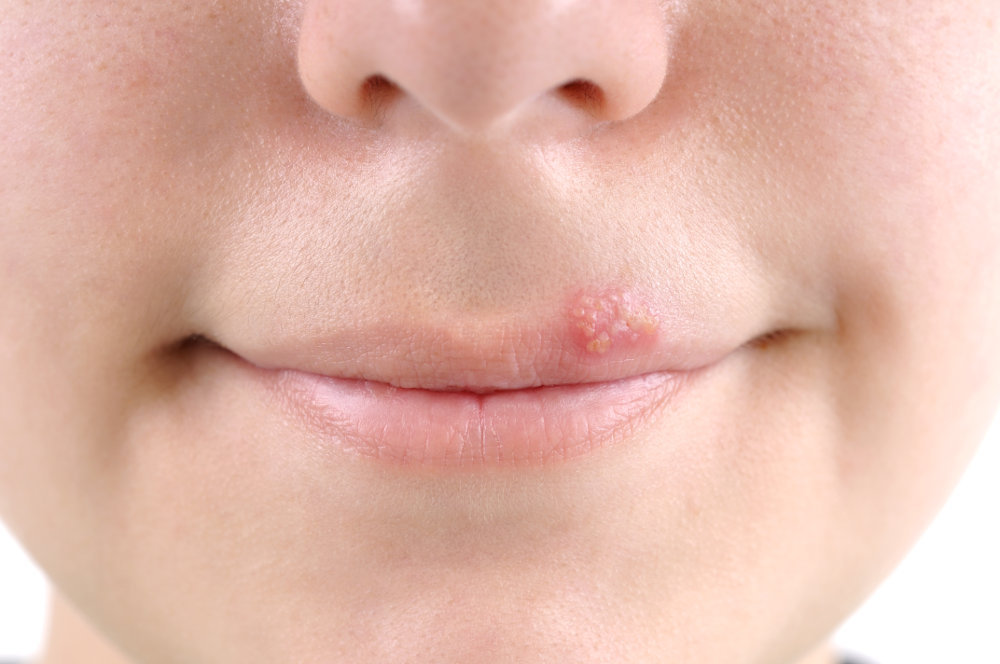 Homemade-Herpes-Remedies-that-Actually-Work-1