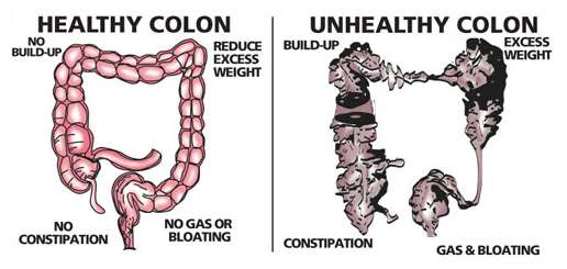 You-Have-Around-20-Pounds-of-Poison-in-Your-Colon- Here’s-How-to-Get-Rid-of-It-1