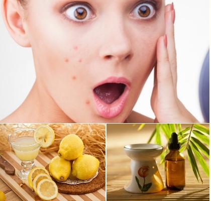 10-Natural-Products-That-Eliminate-Acne-1