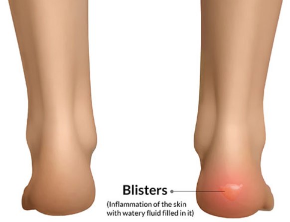 5-Products-That-Will-Help-You-Get-Rid-of-Blisters-1