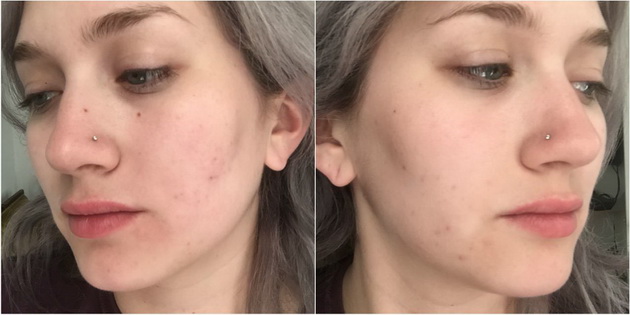 What-Happened-With-My-Face-After-I-Stopped-Picking-on-My-Acne-for-a-Week-2