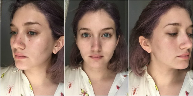 What-Happened-With-My-Face-After-I-Stopped-Picking-on-My-Acne-for-a-Week-3