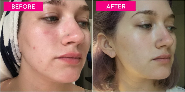 What-Happened-With-My-Face-After-I-Stopped-Picking-on-My-Acne-for-a-Week-4