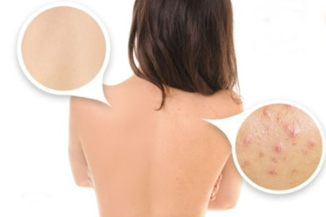 Foods-and-Body-Creams-You-Need-to-Avoid-to-Defeat-Acne-on-Your-Back-1