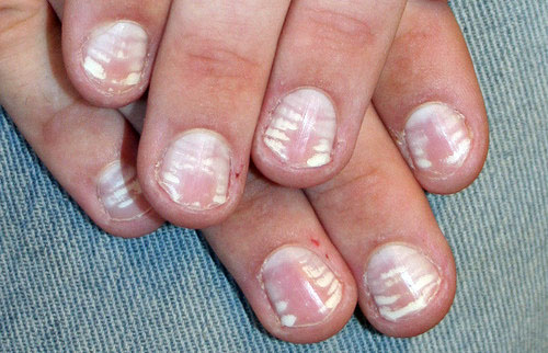 7 Reasons Why You Have White Spots on Your Nails - Women Daily Magazine