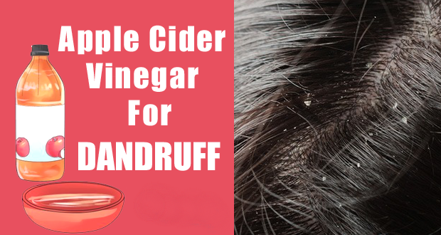 You-Have-Dandruff-and-Nothing-Helps-Check-Out-These-Homemade-Remedies-1