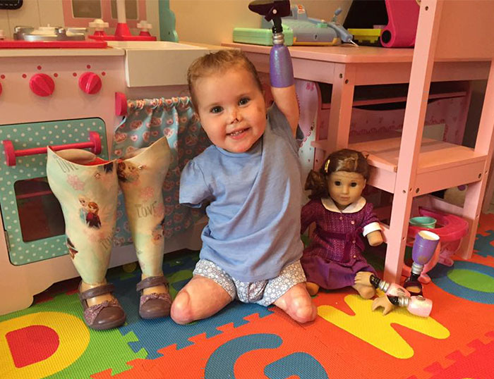 2-year-old-girl-got-legs-arms-amputated-gets-doll-look-just-like-her-1