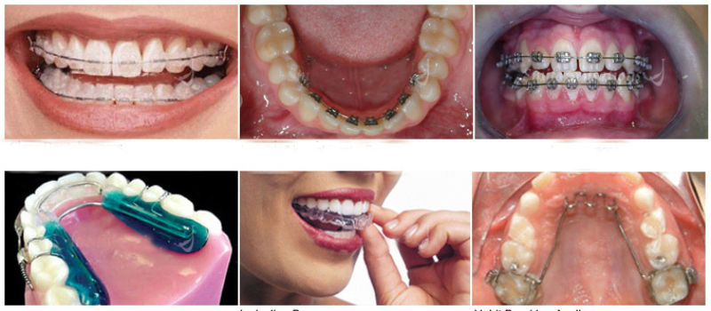 How-to-Preserve-Your-Smile-With-Orthodontics-Dental-Procedures