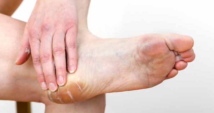 3-amazing-homemade-remedies-for-cracked-heels-1