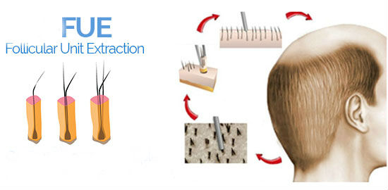 What is FUE Hair Transplant (Follicular Unit Extraction) and How It ...