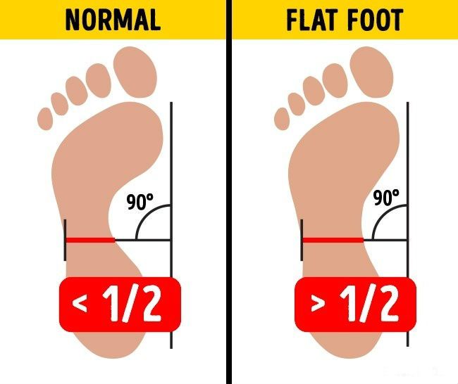 Having Flat Feet Can Destroy Your Knees Here’s How to Alleviate the