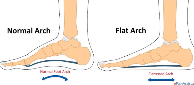 Having Flat Feet Can Destroy Your Knees - Here’s How to Alleviate the ...