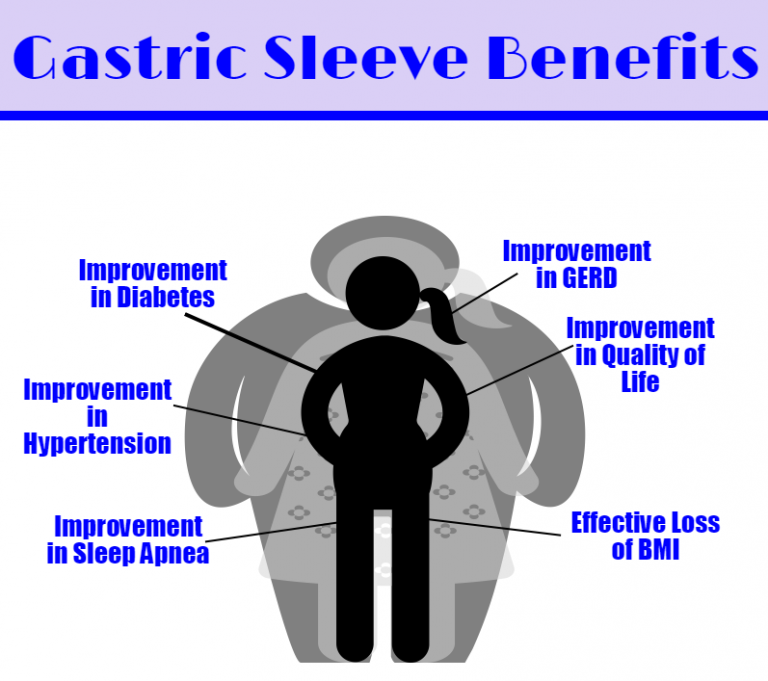 Risks and Rewards of Gastric Sleeve Surgery Women Daily Magazine