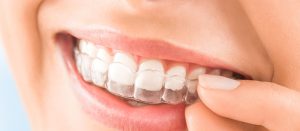 Benefits of Invisalign