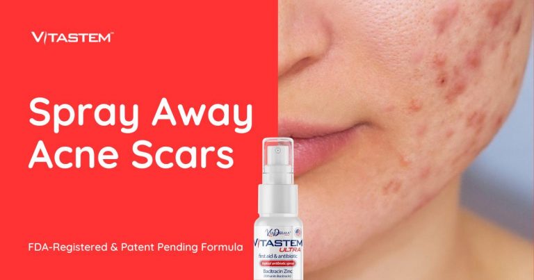 Acne: Types, Causes, Treatment & Prevention - Cleveland Clinic