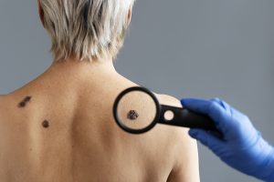 skin cancer surgery