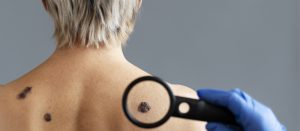 skin cancer surgery